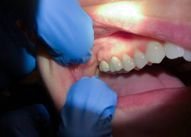 Best Broken or Cracked Tooth Emergency Dentist in Sanford, ME